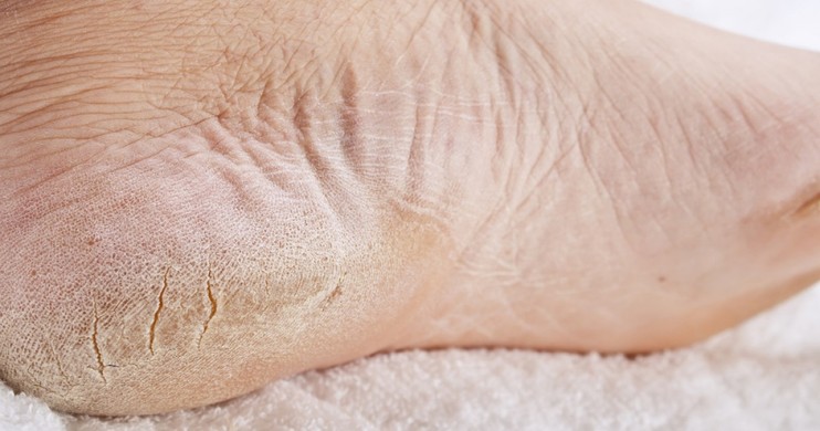 Hasil gambar untuk kaki kering