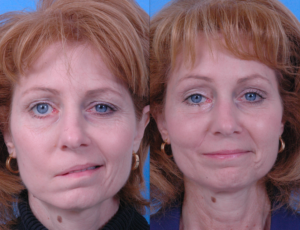 obat bell's palsy